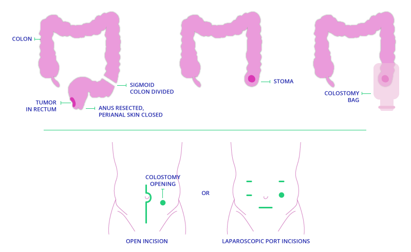 What is TAMIS | Transanal Minimally Invasive Surgery