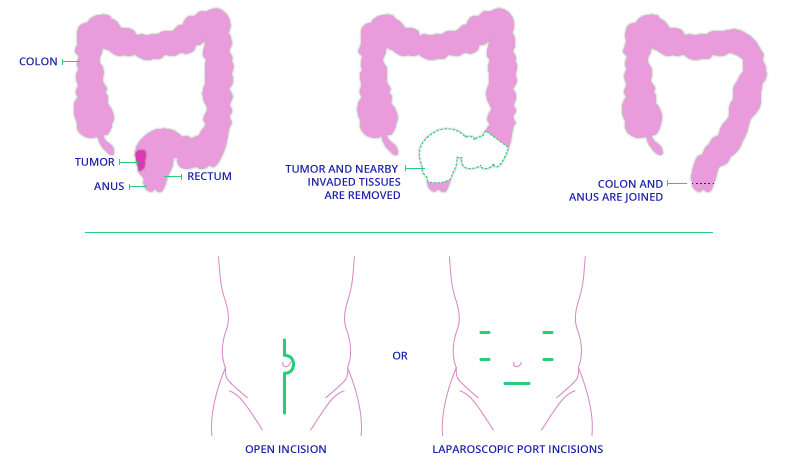 What is TAMIS | Transanal Minimally Invasive Surgery